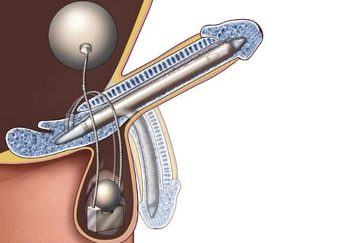 Not Getting Hard Anymore