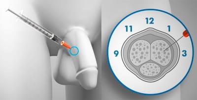 Injection For Erectile Dysfunction